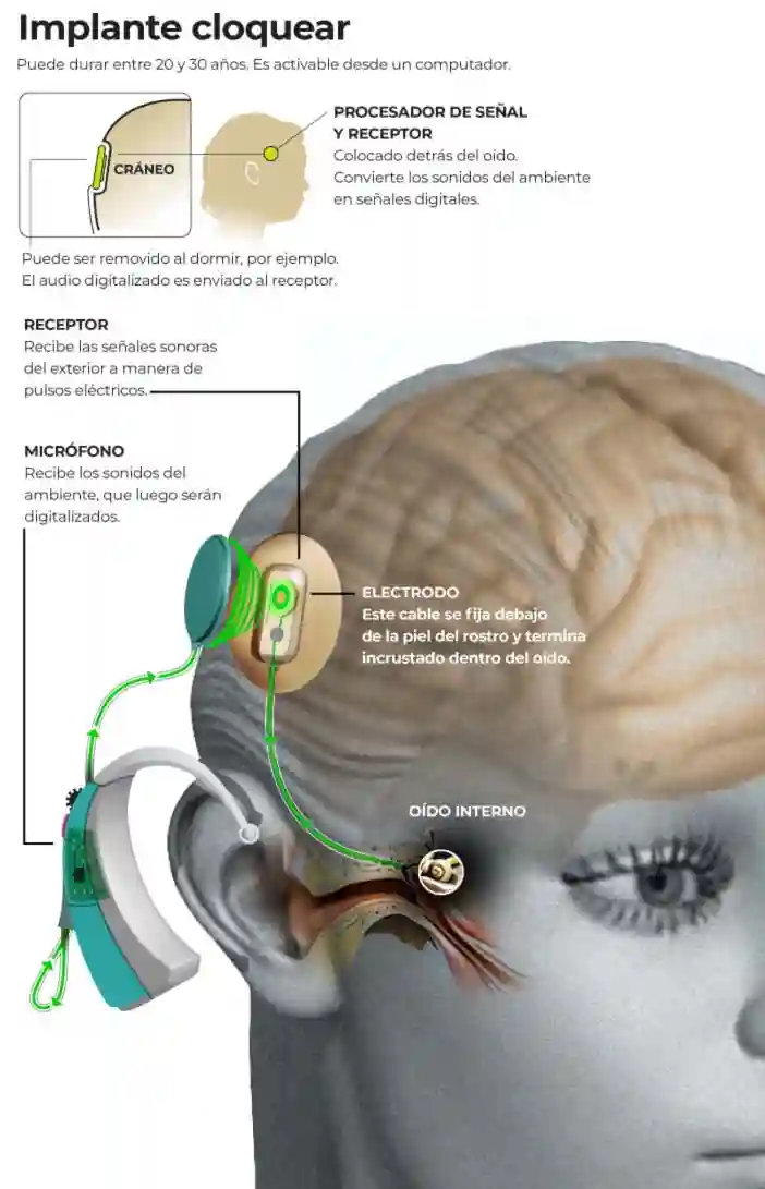 Autor: duduromeroa@. Gráfico a color. Infografía. Implante cloquear (en oído) para recuperación de sentido auditivo. Eduardo J. Romero Andrade. Guayaquil, Ecuador.